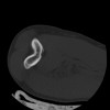SPORK, NICO - 22.03.1976 - 02.08.2022 - CT obere Extremität - 17:59:38